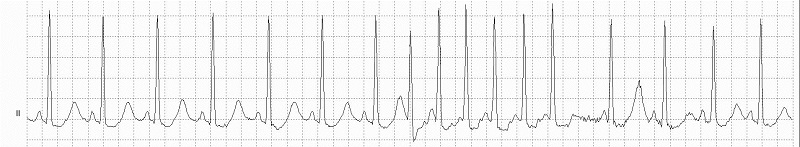 SupraventricularTachycardia Rhythm Strip